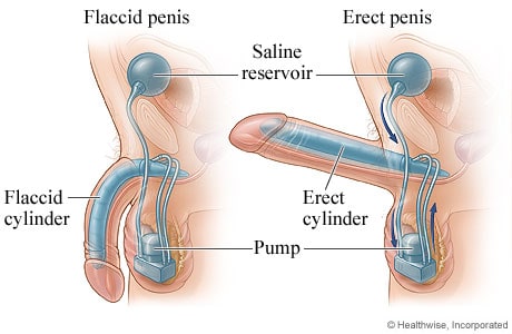 Butea Superba on Erection